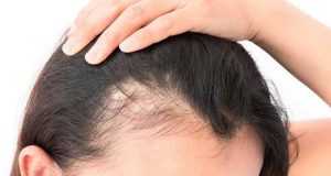 women hair loss treatments 300x160 - أضرار نقص فيتامين د الحاد عند النساء